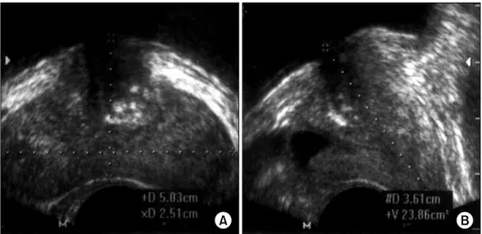 Fig.  1.   Periurethral  prostatic  calculi  within  5mm  from  the  prostatic   ure-thra  of  the  transitional  zone  were  detected  on  transrectal   ultrasono-graphy (TRUS)  findings,  including  more  echogenic  foci  that  caused  acoustic  shadowin
