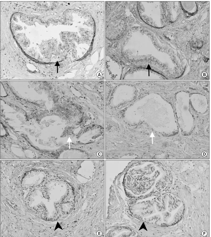 Fig.  1.  Immunohistochemical  staining  for  survivin (A,  B),  bcl-2 (C,  D)  and  ki-67 (E,  F)  in  benign  prostatic  hyperplasia (BPH)  patients  given  finasteride  treatment (B,  D,  F)  and  for  non-treated  patients (A,  C,  E)