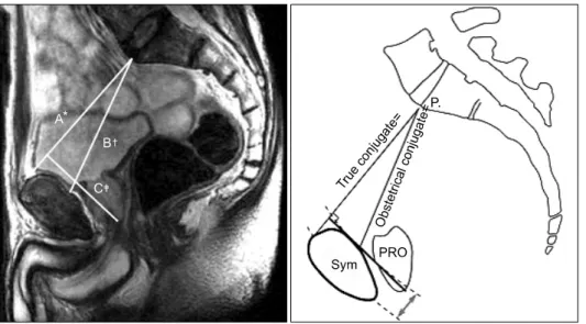 Fig.  1.  Reconstructed  sagittal  image  by  Workstation Ⓡ ,  from  the  prostate  magnetic  resonance  imaging (MRI)  and  schematic  image