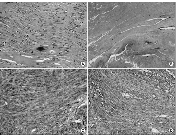 Fig.  2.  (A)  Prostate  is  replaced  by  cellular  tumor  mass.  The  tumor  cells  are  spindle  shaped  with  little  atypia