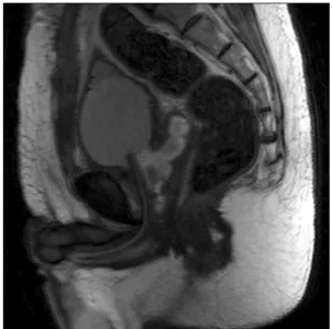 Fig.  3.  MR  prostate  image  showing  open  prostatectomy  state  and  definite  fat  strand  between  the  rectum  and  the  remaining  prostate  capsule.