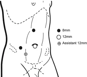 Fig. 1. Port  placement  during  robot-assisted  laparoscopic  left 