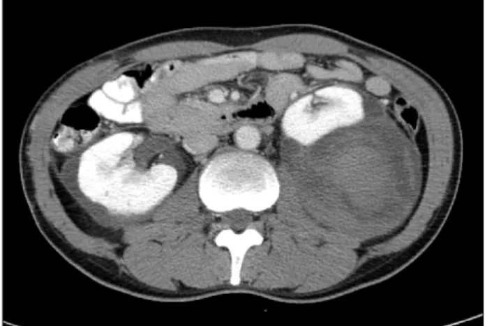 Fig.  2.  The  follow-up  abdominal  computerized  tomography  shows  a  much  decreased  right  renal  cyst.