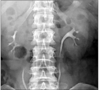 Fig.  1.  Intravenous  pyelography (IVP)  shows  a  filling  defect  in  the  upper  calyx  of  the  left  kidney.