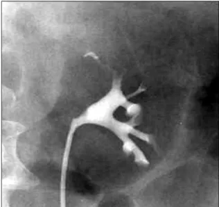 Fig.  2.  Retrograde  pyelography (RGP)  shows  a  filling  defect  in  the  upper  calyx  of  the  left  kidney.