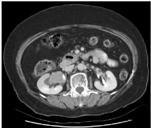 Fig.  1.  CT  scan  demonstrates  a  4x3  cm  tumor  in  the  dilated  right  renal  pelvis.