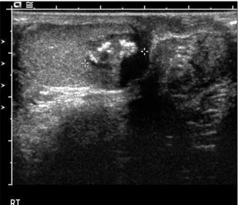 Fig.  2.  The  gross  findings  show  an  ill-demarcated,  pale  tan  to  white,  solid  mass  with  foci  of  necrosis.