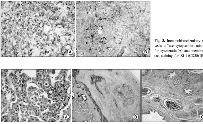 Fig.  3.  Immunohistochemistry  re- re-veals  diffuse  cytoplasmic  staining  for  cytokeratin (A)  and   membran-ous  staining  for  Ki-1 (CD30) (B)