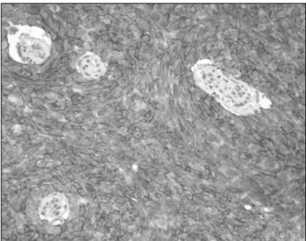 Fig.  1.  Computed  tomography  scan  shows  a  4x4cm  sized  intra- intra-vesical  polypoid  enhancing  mass  with  internal  calcification  in  the 