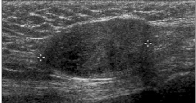 Fig.  1.  Scrotal  ultrasonogram  revealing  an  approximately  2.5x2.0  cm,  oval  shaped,  well  demarcated,  heterogeneous  echogenic  mass  in  the  spermatic  cord.