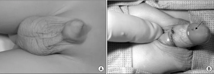 Fig.  2.  Narrow  accessory  dorsal  urethra  in  patient  2  with  prolene  2-0  inserted.