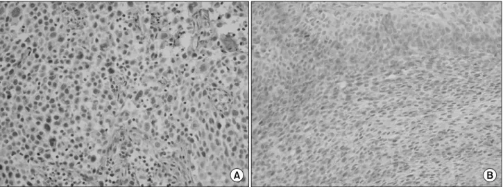 Fig.  1.  Immunohistochemical  staining  of  clusterin.  (A)  Negative, (B)  Positive (x200).
