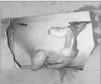 Fig.  1.  The  two  testes  and  one  spermatic  cords  were  delivered  from  the  left  inguinal  area.