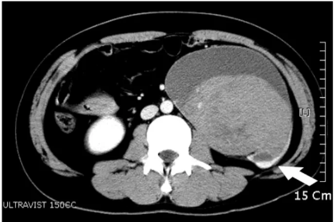 Fig.  1.  Abdominal  computed  tomography  shows  a  large  left  retrop- retrop-eritoneal  mass  with  a  large  hematoma  and  thinning  of  the  left  lower  pole  of  the  parenchyma (arrow).