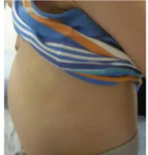 Fig.  1.  The  abdominal  distention  of  front  view  at  the  first  visit  (2009.7.22.)