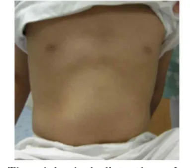 Fig.  4.  The  abdominal  distention  of    side    view  at  the  last  visit(2009.9.15.)