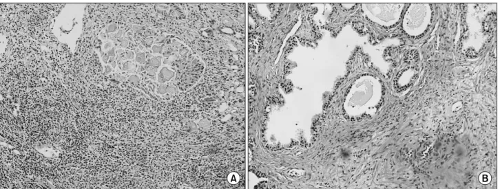 Fig.  3.  The  prostatic  tissue  shows  severe  inflammation (A)  and  mild  inflammation (B)  in  the  stroma,  along  with  involvement  of  the  glandular  epithelium