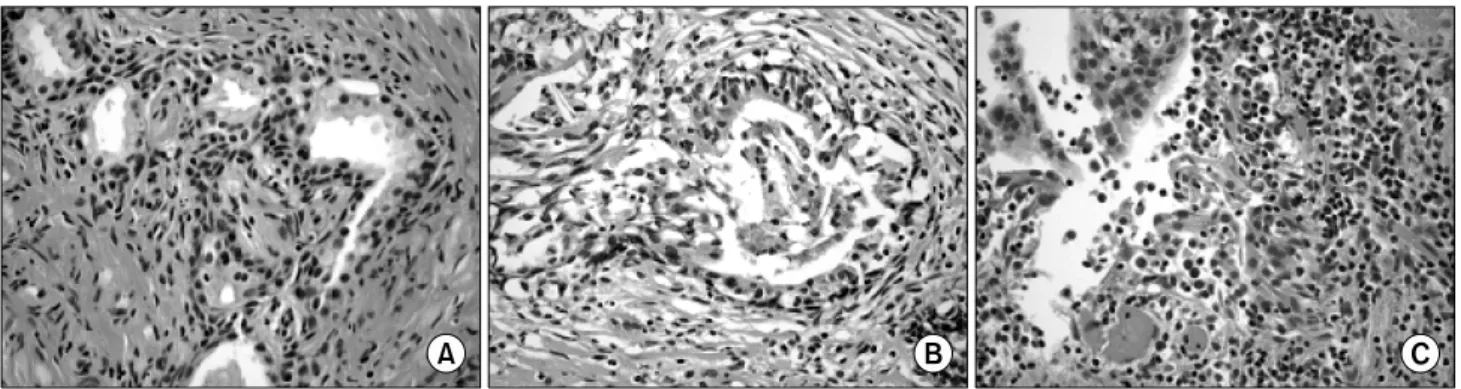 Fig.  2.  Aggressiveness  of  chronic  inflammation  was  graded  on  a  4-point  scale