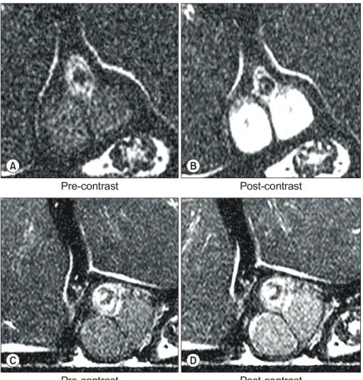 Fig.  3.  T1-weighted  MR  images  of  the  testis  at  30  minutes (A  and  B)  and  2  hours (C  and  D) (TR/TE=320/20)  in  the  embolic  group