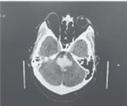 Fig. 1.  Brain CT of the patient 