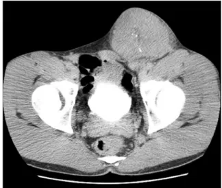 Fig. 1. An abdominal-pelvic computed tomography (CT) scan shows an approximately 9.2x7.3cm sized homogeneous mass lesion in the left inguinal canal