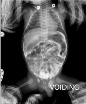 Fig. 4. The voiding cystourethrogram. The cystogram shows contrast-material extravasation from the bladder, outlining the bowel loops within the peritoneal cavity.