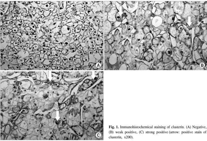 Fig. 1. Immunohistochemical staining of clusterin. (A) Negative, (B) weak positive, (C) strong positive (arrow: positive stain of clusterin, x200).