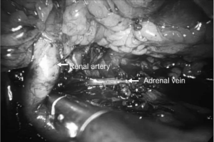 Table 2. Comparison of the intraoperative parameters between re- re-troperitoneal (RLA, n=18) and transperitoneal (TLA, n=10)  laparo-scopic adrenalectomies