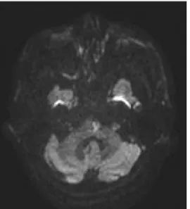 Fig. 2.  Brain diffusion weighted imaging
