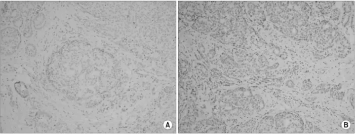 Fig. 2. Immunohistochemical staining for the prostate-specific antigen (PSA) (A) and prostate associated protein antigen (PAP) (B) showing negative reactions in a breast ductal carcinoma.