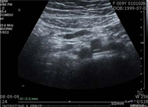 Fig.  1.  US(intestine  &amp;  peritoneal  cavity)Ⅰ.  緖    論복통은 소아에서 흔히 접하는 증상으로 급성과 만성 또는 기능적 복통과 기질적 원인 질환에 의한 복통으로 분류된다