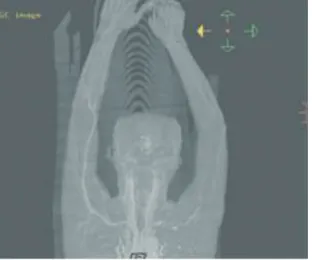 Fig. 3.  Upper extremity angio CT (12.8)