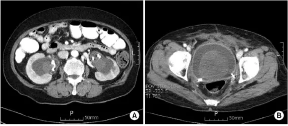Fig. 2. (A) Bilateral renal angio- angio-gram shows no definite abnormal lesion. Ureteral stents are well  posi-tioned bilaterally and contrast of previously taken computed  tomo-graphy (CT) is still remained in  de-scending colon