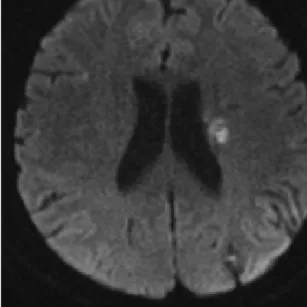 Fig. 1.    Diffusion  findings  of  the  brain.  (X- (X-1.11.21.) High signal intensity lesion on  dwi at left corona radiata.