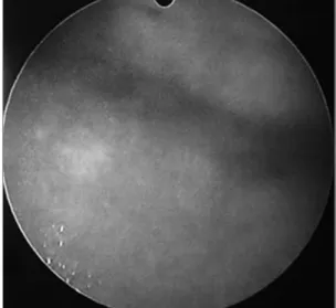 Fig. 4. No definitive mass on the bladder or wall thickening are found (post-treatment).