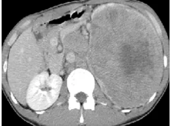 Fig. 1. The computed tomography scan shows a 16x15cm sized- sized-ill defined mass in the left kidney and the associated multiple lymph nodes in paraaortic and left renal hilar areas.
