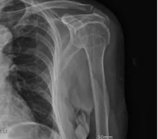 Fig. 2.    Shoulder AP Lateral Left (2017-09-26)