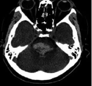 Fig. 1. Computed Tomography (CT) findings of the  brain. (2015. 11. 12.)