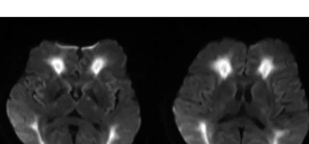 Fig. 1. Brain MR diffusion of patient(2016. 05. 05.)
