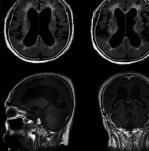 Fig. 1. Brain MRI (DWI / T2 FLAIR) : Lt. pontine inf.
