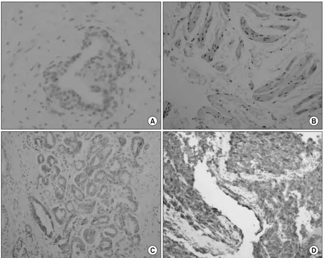 Fig.  1.  P504S  staining  of  the  human  prostate  (A)  P504S  negative  staining (x400)  specimens  at  the  intracytoplasm,  (B)  P504S  weak  staining (x200)  of  the  intracytoplasm,  (C)  P504S  moderate  staining (x200)  of  the  intracytoplasm  an