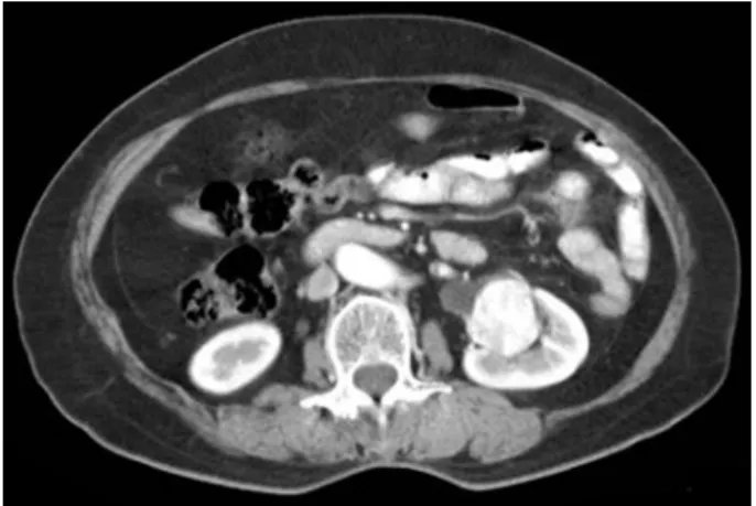 Fig.  1.  Contrast-enhanced  CT  scan  shows  a  3x3cm  sized,  enhanced,  well-demarcated  mass  in  the  left  renal  pelvis  area.