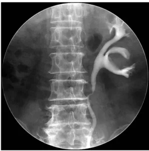 Fig.  2.  Left  retrograde  pyelogram  demonstrates  a  mass  extrinsically  compressing  infundibula  between  mid  and  lower  calyx.