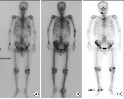 Fig.  1.  Serial  changes  of  bone  scan  finding.  (A)  Initial  bone  scan,  (B)  38  months  later (after  second  line  hormone  therapy),  (C)  57  months  later (after  estramustine   withdra-wal).