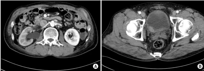 Fig.  1.  Contrast-enhanced  CT  scan  of  the  abdomen  showed  the  right  hydronephrosis,  delayed  nephrogram,  perinephric  infiltration (A)  and  focally  enhancing  wall  thickening  at  the  right  posterolateral  bladder  wall,  and  this  involve