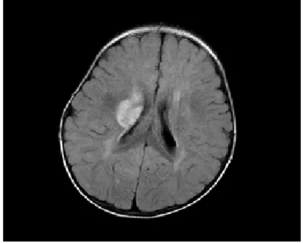 Fig. 1. Brain MRI 5.  가족력  및  과거력특이사항 없음.6.  치료  기간 2007년  12월  20일부터  2008년  2월  19일간 통원 치료 7