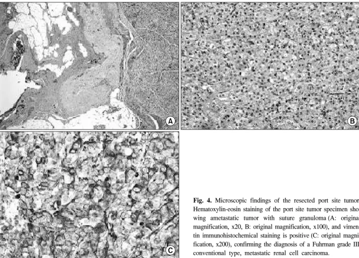 Fig.  4.  Microscopic  findings  of  the  resected  port  site  tumor. 