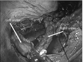 Fig.  6.  After  dissecting  beneath  the  sigmoid  colon,  we  transported  the  left  ureter  from  left  to  right  through  the  sigmoid  colon.