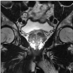 Fig.  2.  Contrast  enhanced  magnetic  resonance  imaging  of  the  pelvis  shows  the  prosthesis  materials  in  the  corpus  cavernosum.