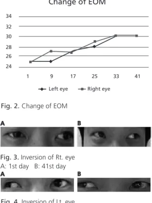 Fig. 4. Inversion of Lt. eye A: 1st day   B: 41st day Fig. 3. Inversion of Rt. eye A: 1st day   B: 41st dayA
